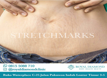 Stretchmarks
