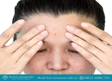 Twinlight Acne Scar
